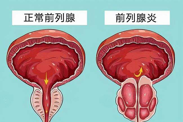 此病是患者的尿道感染上了炎症引起來的,此病的常見症狀是尿頻,尿急和